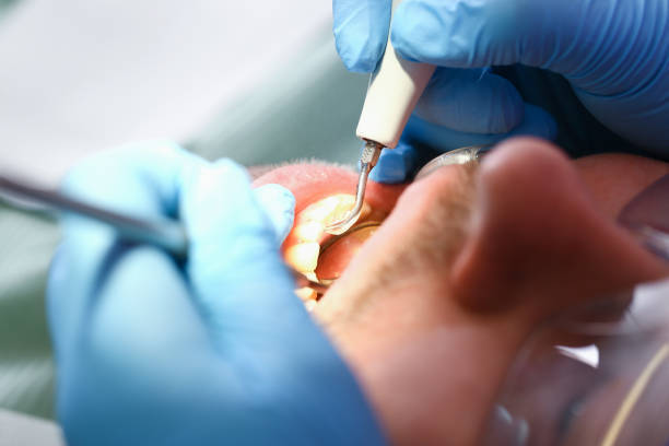 Best Emergency Dentist for Lost Fillings or Crowns in Durango, CO